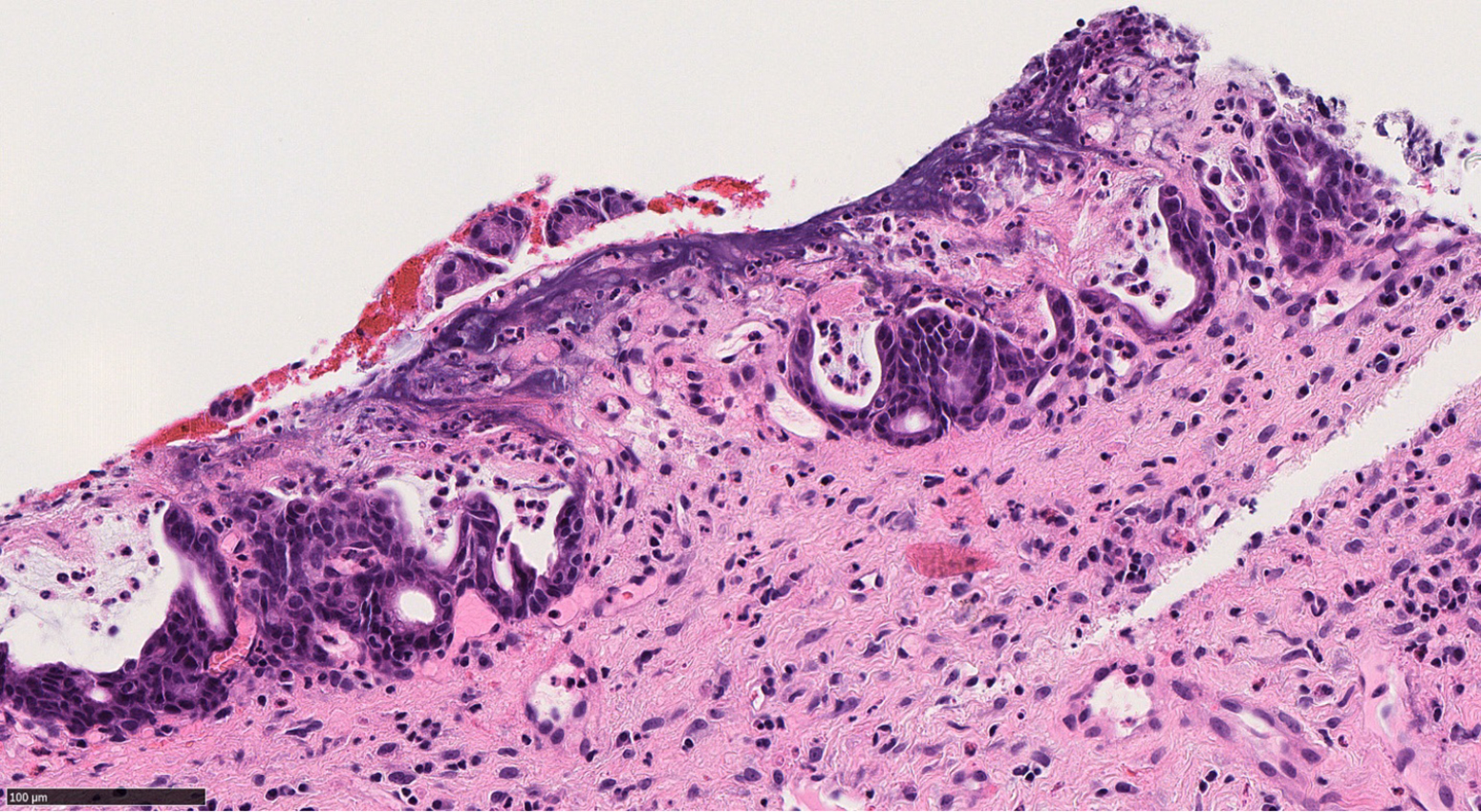 Benign Vs Malignant Pancreatic Lesions Molecular Insights To An Ongoing Debate